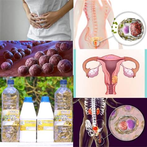 th?q=Comment+soigner+la+chlamydia+sans+ordonnance+