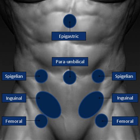 Common hernie types #healthwellness #foryou #fyp #hernia #healthinfo …