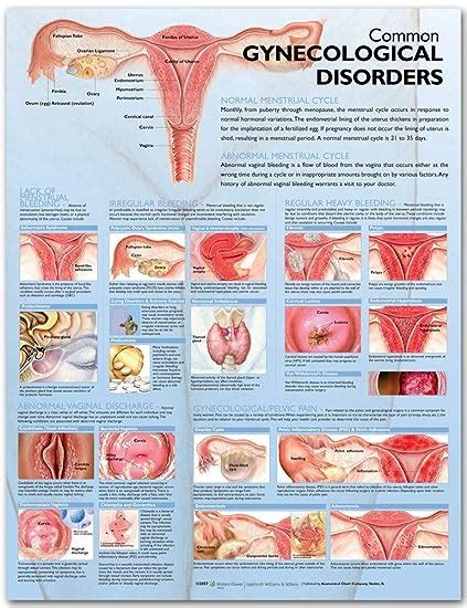 Read Online Common Gynecological Disorders Anatomical Chart By Anatomical Chart Company