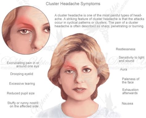 CommonCausesofLeftEyeandHeadPain