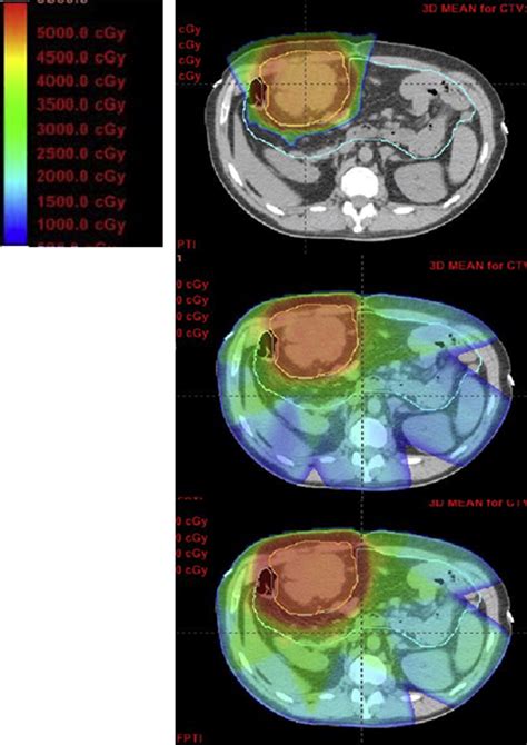 Comparison of 3D Conformal Proton Therapy, Intensity …