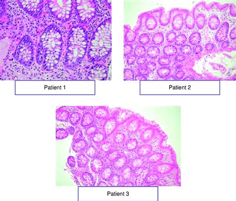 Comparison of Colonoscopy and Histopathological Findings in Terminal.