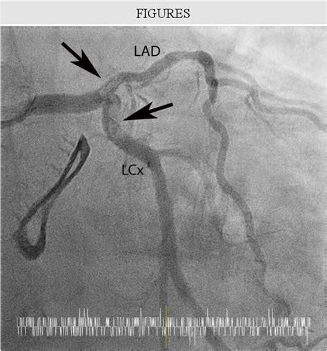 Complementary role of computed tomography angiography with …