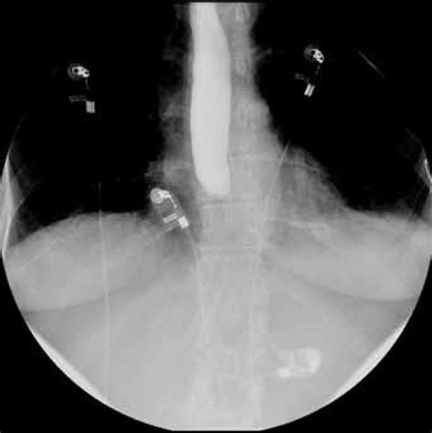 Complete esophageal obstruction following endoscopic variceal …