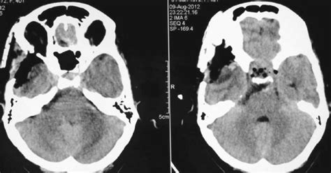 Complete resection of a cavernous haemangioma of the optic