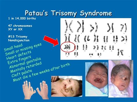 Complete trisomy 20 syndrome (Concept Id: C0265479)