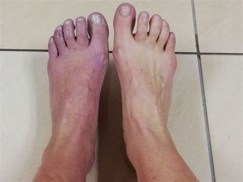 Complex Regional Pain Syndrome in the Foot - Physiopedia