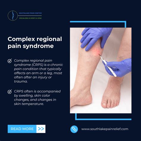 Complex Regional Pain Syndromes - Medscape