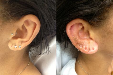 Complications of Ear Piercing: Perichondritis and Ear Disfigurement