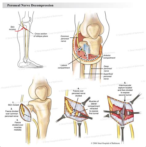 Complications of peroneal nerve decompression surgery. .  <a href=https://stag....