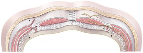 Component separation is an abdominal wall reconstructive technique that strategically divides the rectus and lateral abdominal wall musculofascial layers in order to achieve tension-free midline fascial approximation.
