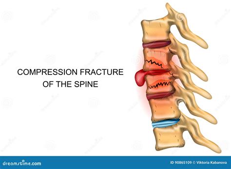 Compression Fracture Thoracic Spine