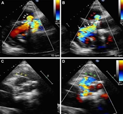 Compression of the right coronary artery by an aortic pseudoaneurysm ...