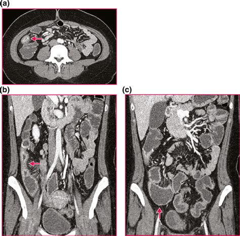 Computed Tomography (CT) Enterography - Radiologyinfo.org