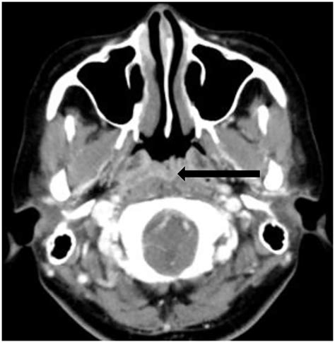 Computed tomographic findings of nasopharyngeal carcinoma …