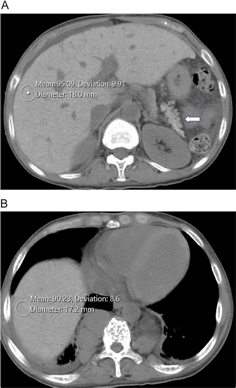 Computed tomography of hyper-attenuated liver: Pictorial essay