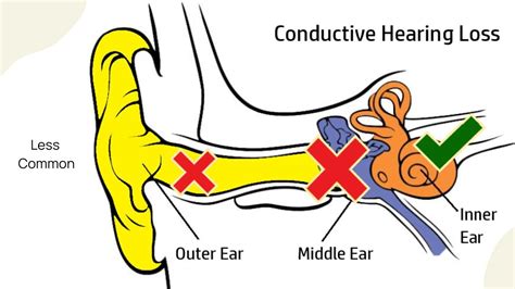 Conductive Hearing Loss F049 SOP Information, SOPs …