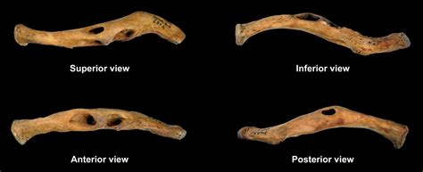 Congenital Anatomical Variant of the Clavicle - Viciano - 2024