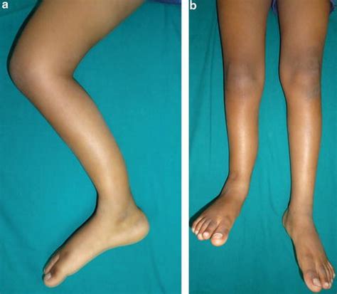 Congenital Lower Limb Deformities SpringerLink