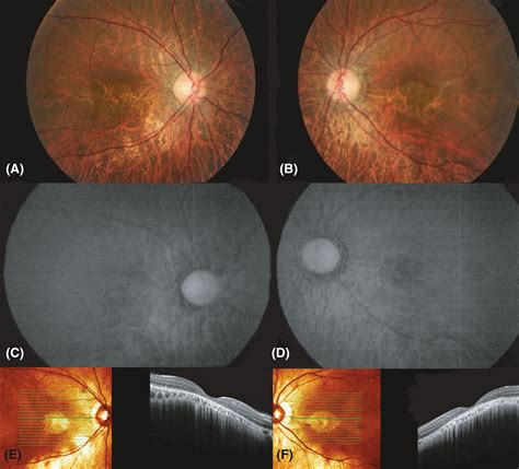 Congenital Stationary Night Blindness - PubMed