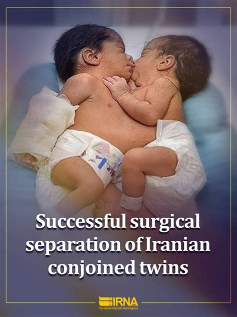 Conjoined Twins Development Delivery and Separation