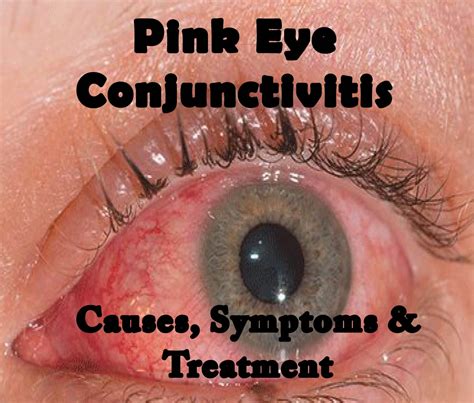 Conjunctivitis Swollen Eye