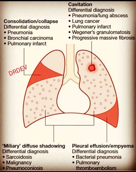 Consolidation of the Lung in Pneumonia Meaning and Symptoms