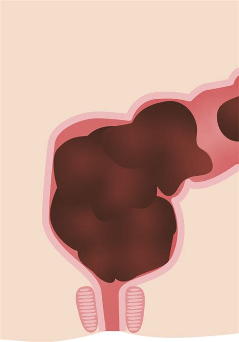 Constipation Concise Medical Knowledge