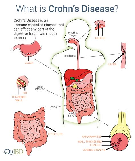 Consumer Health: Treating Crohn