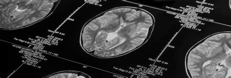 Contrast agents - Innovation for MRI