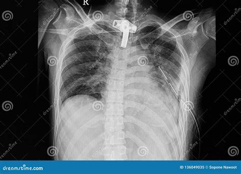 Contusio Musculorum Icd 10: ICD-10-CM Diagnosis Code S10.93XA: Contusion of 2025 ICD-10-CM Diagnosis Code S10.93XA: Contusion of image 1
