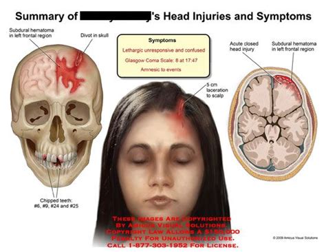 Contusion forehead icd 10. The ICD code S00 is used to code Bruise. A bruise, or contusion, is a type of hematoma of tissue in which capillaries and sometimes venules are damaged by trauma, allowing blood to seep, hemorrhage, or extravasate into the surrounding interstitial tissues. 