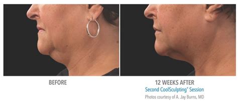 CoolSculpting Sterling, Virginia Physician Artistry