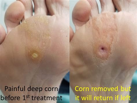 Corn on foot bottom.  5 days ago · Bottom Line Corns don&rsquo;t have t...