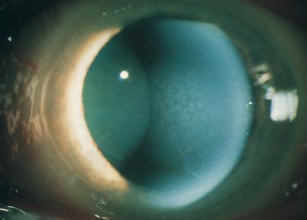 Corneal Dystrophies Ento Key