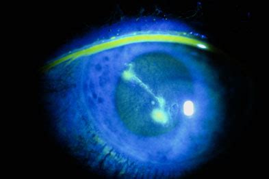 Corneal superficial injury Health topics A to Z CKS NICE