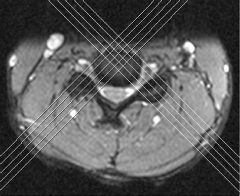 Coronal oblique orientation offers improved visualization of ...