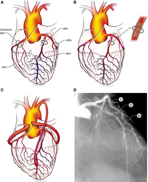 Coronary Angioplasty in Diabetic Patients Circulation