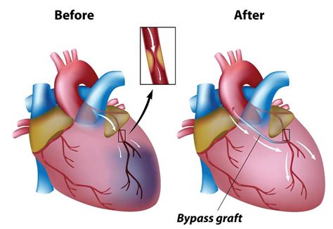 Coronary Artery Bypass Grafting: Purpose, Procedure, Benefits and Side …