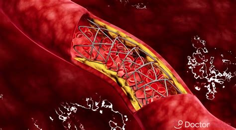 Coronary Heart Disease - an overview ScienceDirect Topics