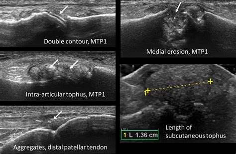 Correspondence on ‘Ultrasound shows rapid reduction of crystal ...