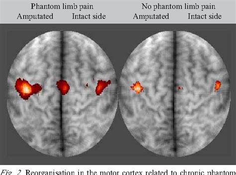 Cortical reorganisation and chronic pain: implications for ...