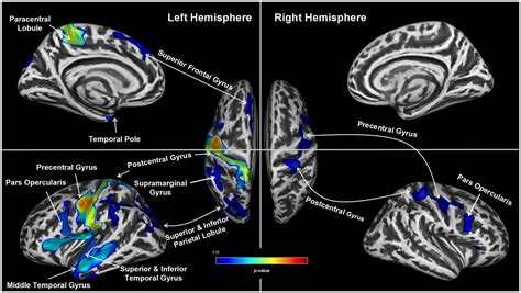 Cortical thinning in male obstructive sleep apnoea patients with ...