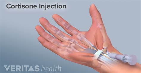 Corticosteroid Injection for Carpal Tunnel Syndrome