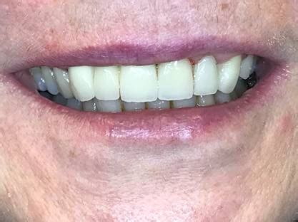 Cosmetic Dental Veneers - Fogg & Whittingham Surgery - FCW