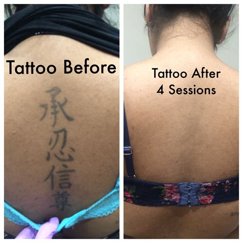 Cost of tattoo removal. Our Laser Tattoo Removal Cost In Texas. At Glow MedSpa, we want you to feel confident in your own skin! That’s why we offer competitive pricing for our services, including laser tattoo removal. The cost will vary based on several factors, such as the size, color, and depth of your tattoo and the number of treatments required. 