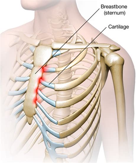Costochondritis lump. Sep 15, 2009 · Costochondritis is a self-limited condition defined as inflammation of costochondral junctions of ribs or chondrosternal joints, usually at multiple levels and lacking swelling or induration. Pain ... 