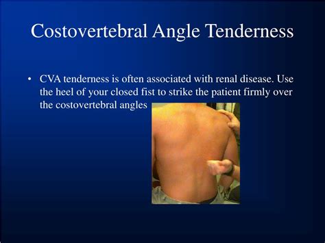 Costovertebral Angle Tenderness Exam CVA …