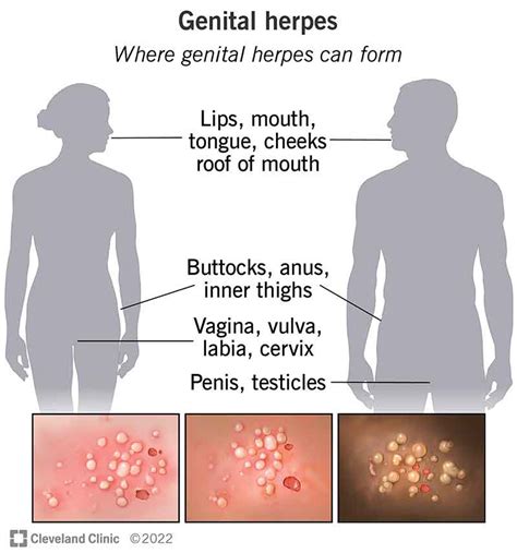 Could this be herpes or something else more serious? Genital Herpes …