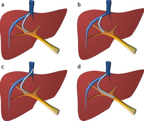 Covered Transjugular Intrahepatic Portosystemic Shunt …